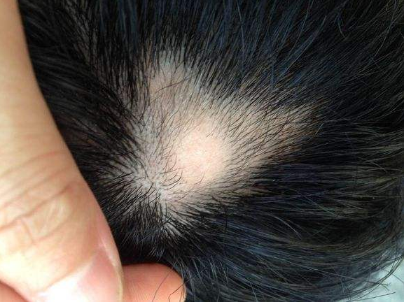 斑秃.png 斑秃.png