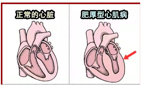 肥厚型心肌病.png