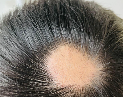 斑秃.png 斑秃.png