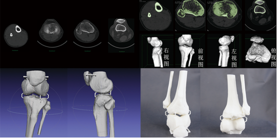 3d打印骨科 3d打印骨科
