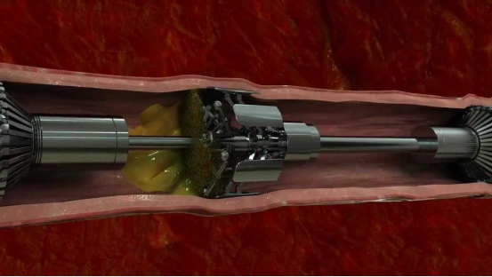 微型机器人清除血栓 微型机器人清除血栓