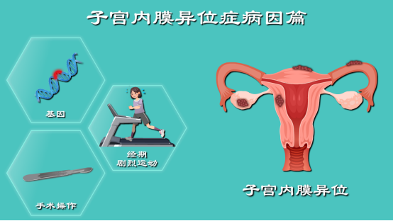 子宫内膜异位症病理 子宫内膜异位症病理