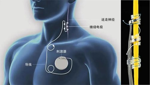 植入式胃电刺激器三维结构