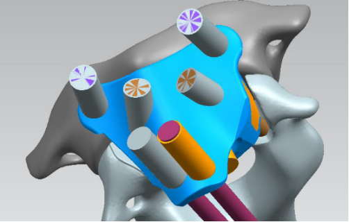 南方医院脊柱骨科完成国内首例单一前路经口腔枢椎肿瘤切除+3D打印人工椎体置换术-南方医科大学新闻中心