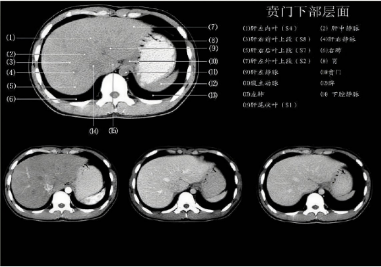 健康与受损肝脏CT