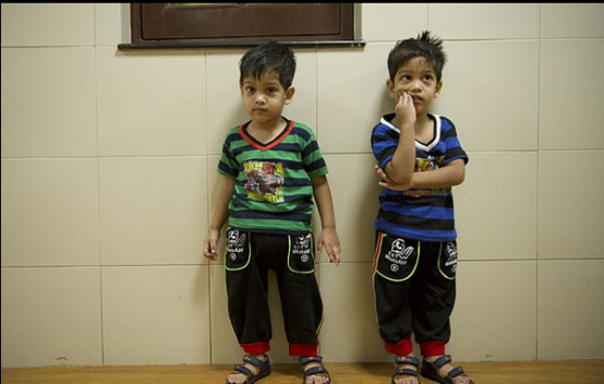 双胞胎分离手术成功