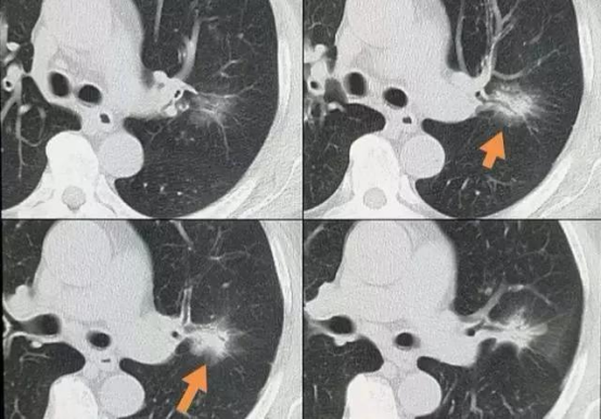 良性结节VS恶性结节