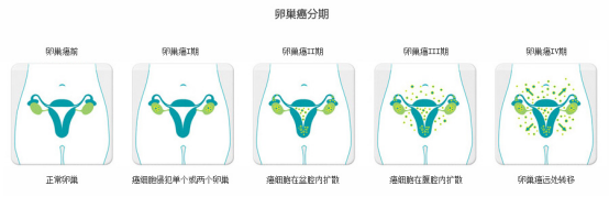 卵巢癌分期