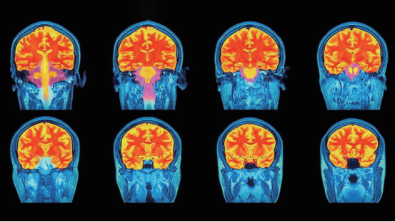 脑神经影像对比图