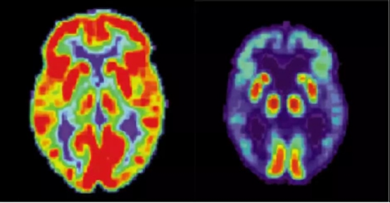 正常大脑与阿尔茨海默病患者大脑PET影像