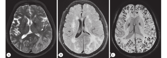 药物清除脑内淀粉样斑块