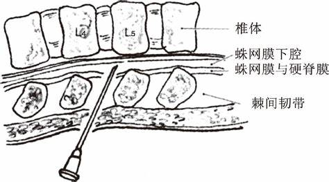 腰椎穿刺