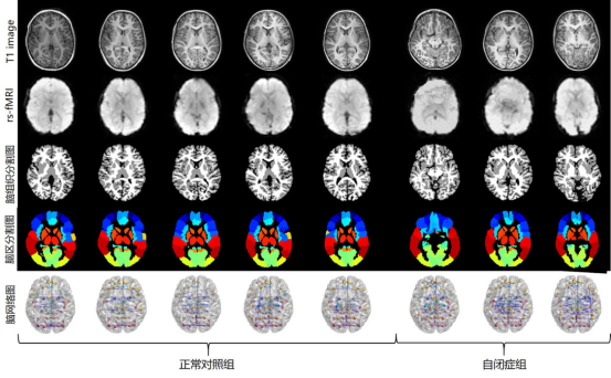 正常人与患者脑部mHTT蛋白分布对比热力图