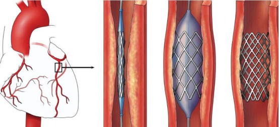 两种支架血管