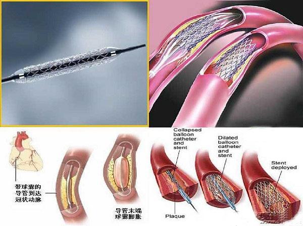 支架降解与血管修复时间轴