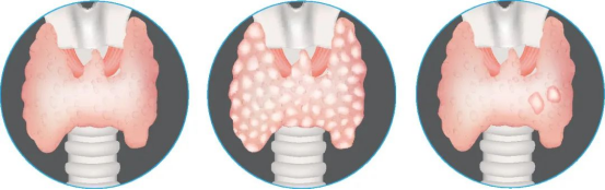 甲状腺结节风险分层示意图