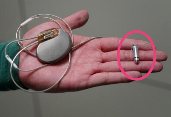 传统DBS与无导线DBS