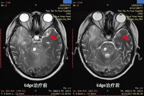治疗前后脑部影像