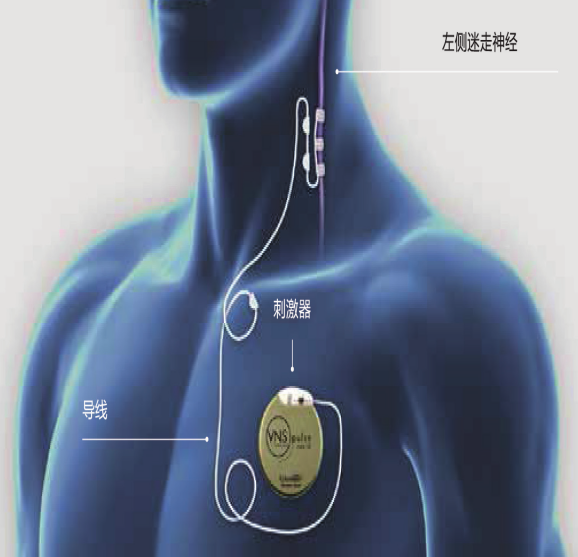 无导线DBS治疗流程图