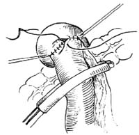 手术缝合痛点、吻合口瘘发生率