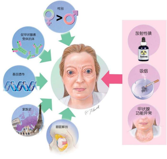 甲状腺眼病治疗方案、精准用药