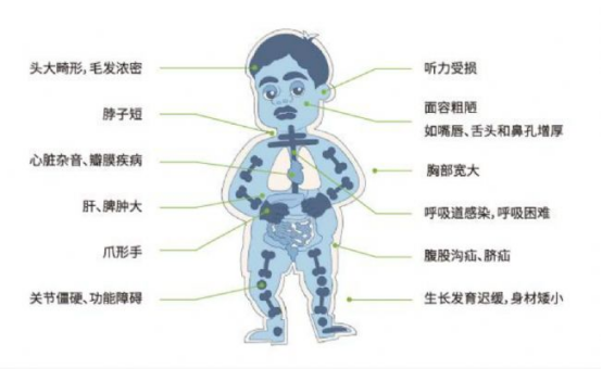 黏多糖患儿特征性面容与基因药物冻干粉对比图，标注"一针改变人生轨迹的魔法粉末