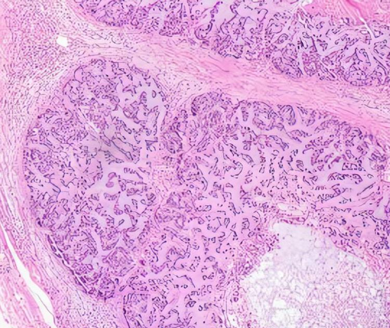 胰腺肿瘤细胞电镜对比图，左侧为正常细胞膜结构，右侧显示电击后纳米级孔洞