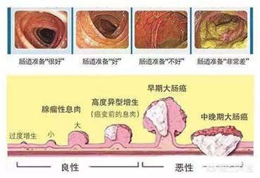 治疗前后肠镜对比