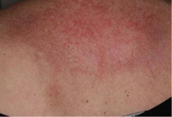 法布里病皮肤病变