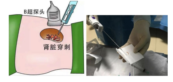 ERT治疗前后肾脏活检电镜