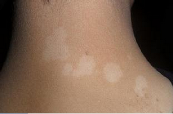 展示CRISPR技术攻克白癜风