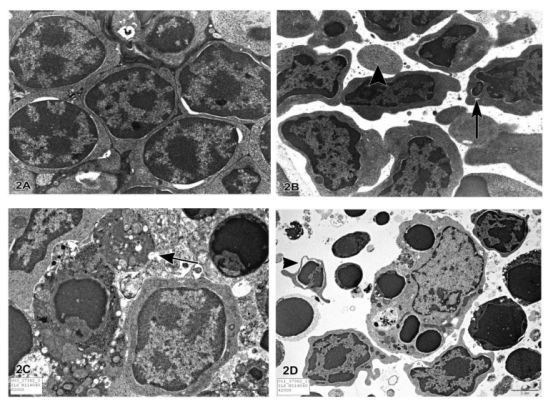 正常肌肉细胞与庞贝氏症细胞电镜对比图
