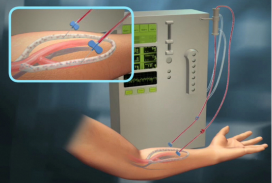 不同年代透析设备对比图，血管通路感染案例照片