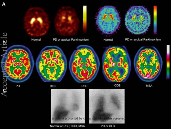 健康人与帕金森患者嗅球体积MRI对比图
