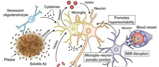 β淀粉样斑块与神经纤维缠结的显微对比图，健康与病变脑区代谢对比热力图