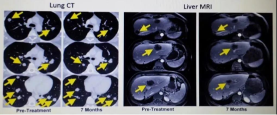 治疗前后MRI对比及患儿绘画作品组图