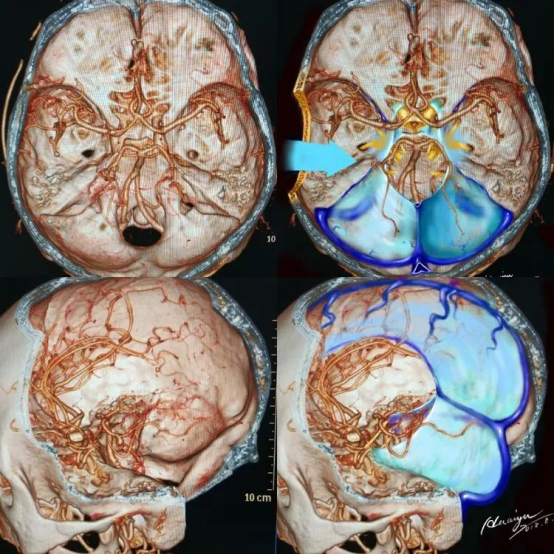 治疗前后脑神经连接对比图及患者艺术作品