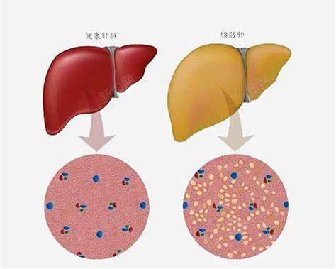 正常肝脏与脂肪肝解剖对比