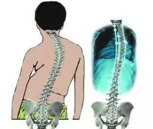 脊柱侧弯自然病程发展示意图 脊柱侧弯自然病程发展示意图