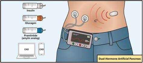 人工胰腺系统工作原理动态图
