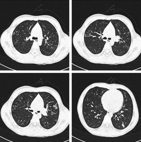 电子烟肺病与传统肺炎CT影像对比图