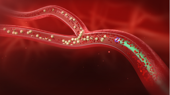 钇-90微球治疗过程三维动画示意图钇-90微球