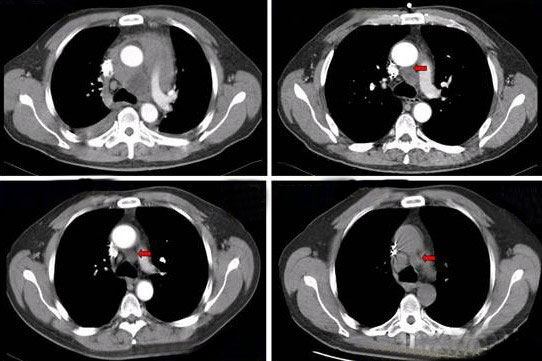 治疗前后CT影像对比图，标注肿瘤体积变化
