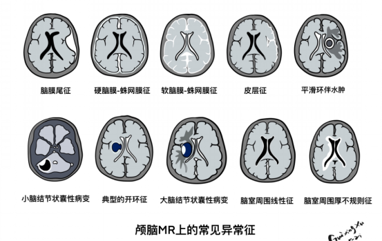 脑部CT影像与记忆测试量表对比图