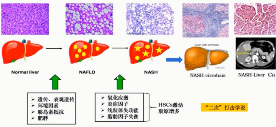 健康肝脏→脂肪肝→肝纤维化→肝癌的病理切片对比