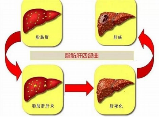 脂肪肝危险因素雷达图+风险评分表