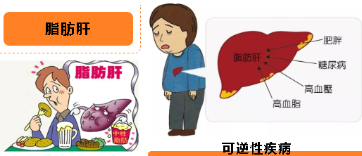 脂肪肝恶化预警症状清单