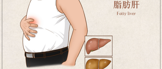 脂肪肝