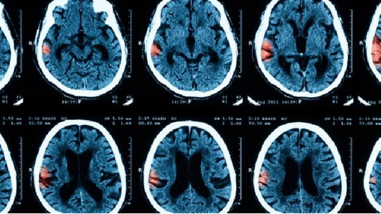 健康青年大脑VS患者脑部MRI