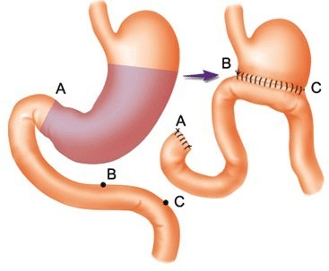 切胃手术 切胃手术